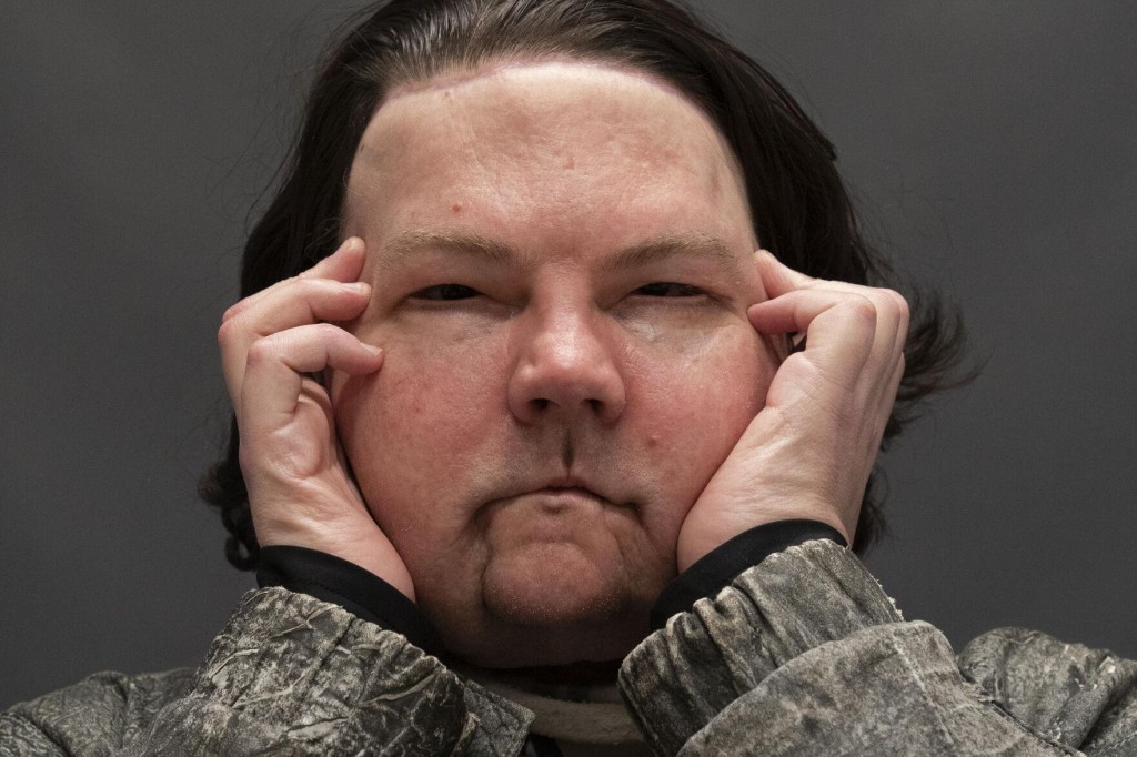 Rare Face, Hands Transplant Gives New Jersey Man ‘new Chance At Life’