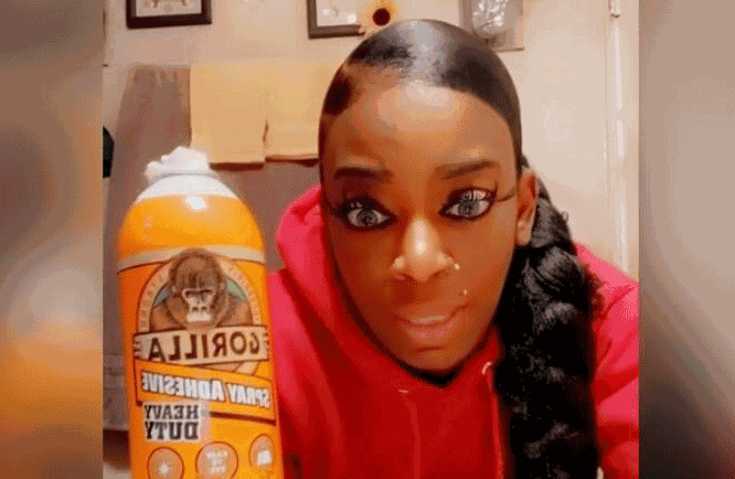 Surgery Finally Frees ‘gorilla Glue Girl’ From Sticky Situation