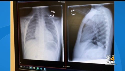 Nh Girl Nearly Killed After Small Piece Of Glass Punctures Lung