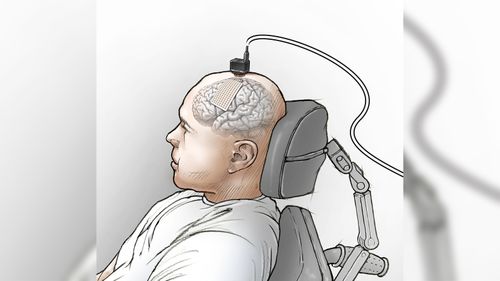 Brain Implant Helps Man ‘speak’ Through A Computer