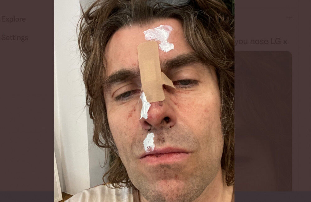 Liam Gallagher Cancels Belfast Gig After Helicopter Fall