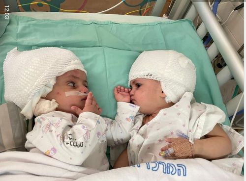 Twins Joined At The Head Are Separated After 12 Hour Surgery In Israel