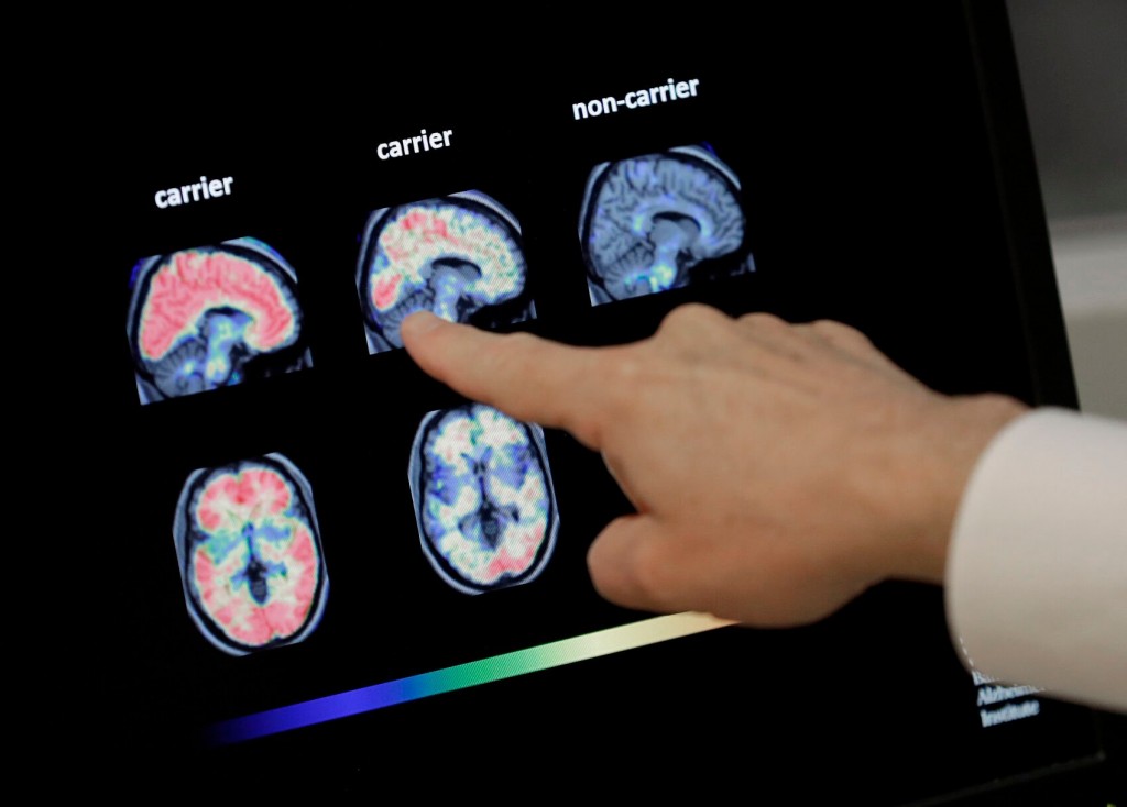 Nasal Vaccine For Alzheimer’s Disease Tested In First Human Trial