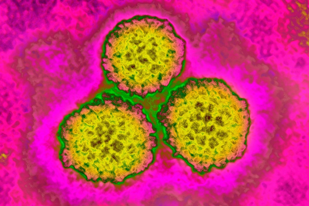 Hpv Vaccine Reduced Cervical Cancer Rates By 87% In Women, Uk Study Finds