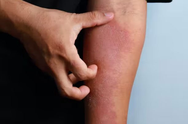 What Is That Rash? Genetic Fingerprints Can Help Doctors Better Diagnose, Treat Skin Conditions