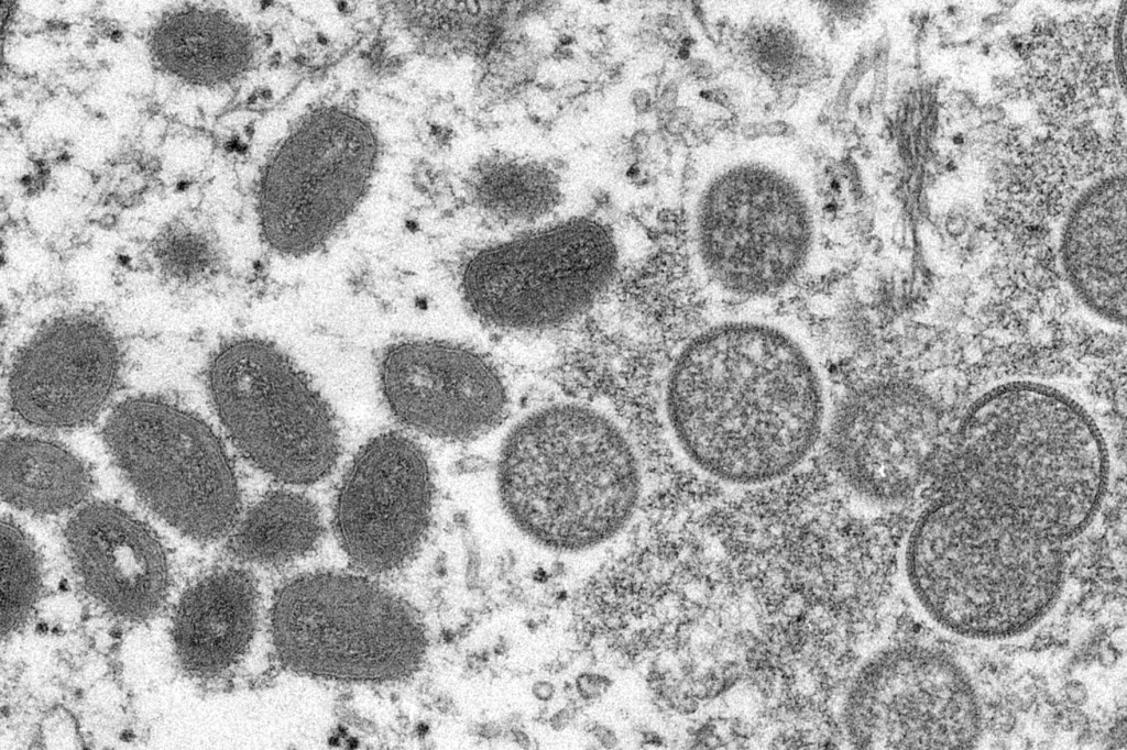 Expert: Monkeypox Likely Spread By Sex At 2 Raves In Europe