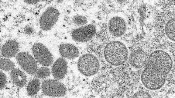 More Than 100 Confirmed Or Suspected Cases Of Monkeypox Have Been Reported In 12 Countries, Including The Us