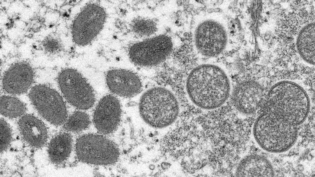 What Is Monkeypox And Its Signs And Symptoms?