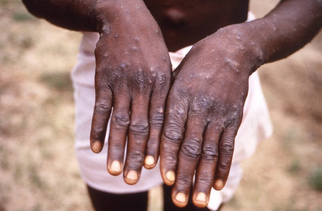 Un Health Agency Declares Monkeypox A Global Emergency