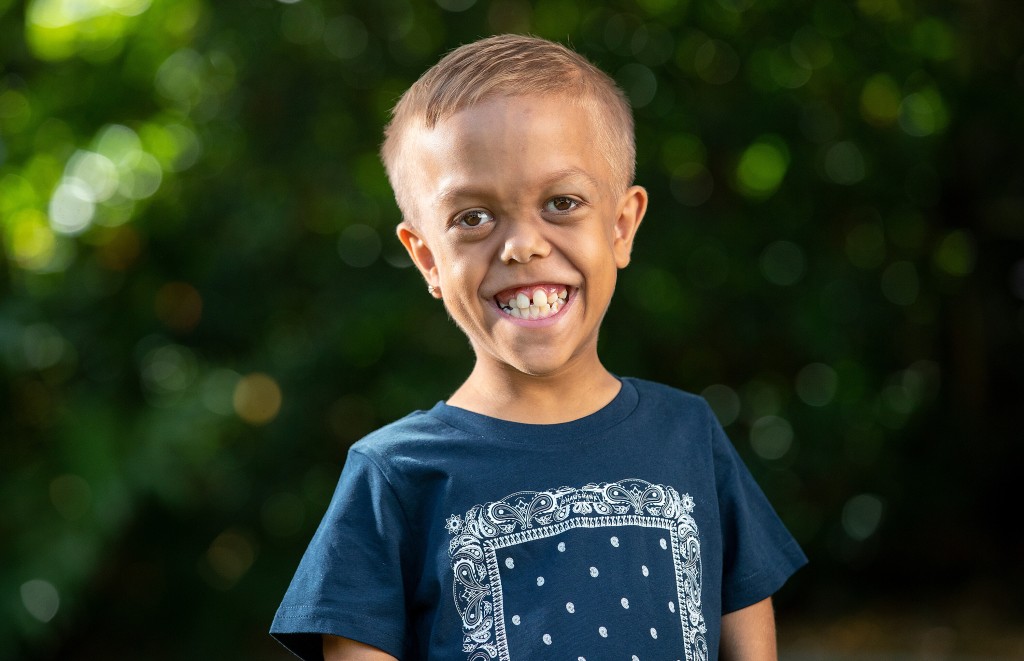 Bullied Boy With Dwarfism Scores Role In New ‘mad Max’ Movie