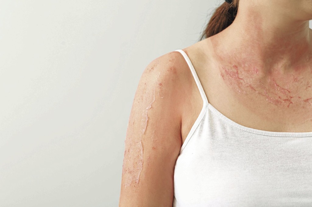 3 Ways To Soothe Your Sunburn When It Starts To Peel