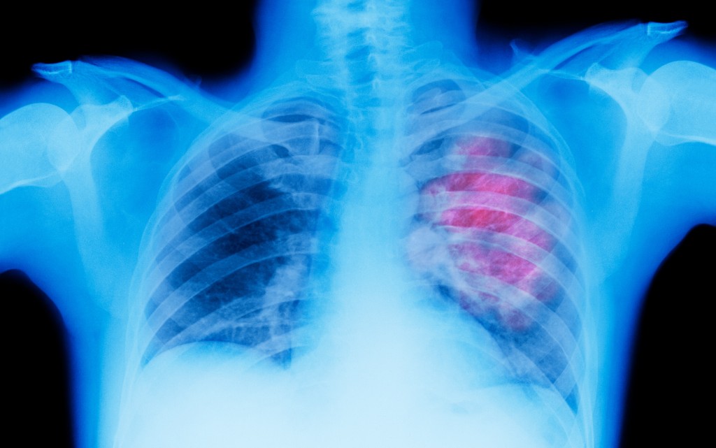 Almost Half Of Cancer Deaths Globally Are Attributable To Preventable Risk Factors, New Study Suggests