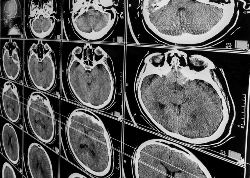 6 Most Common Causes Of Traumatic Brain Injuries