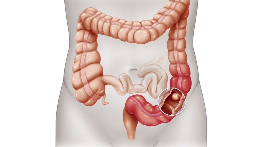 What To Know About Colonoscopy After Study Questions Its Effectiveness