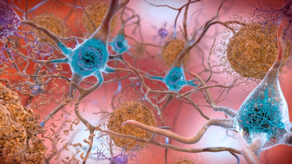 Promising Drug Slows Alzheimer’s, But Can It Make A Real Difference?
