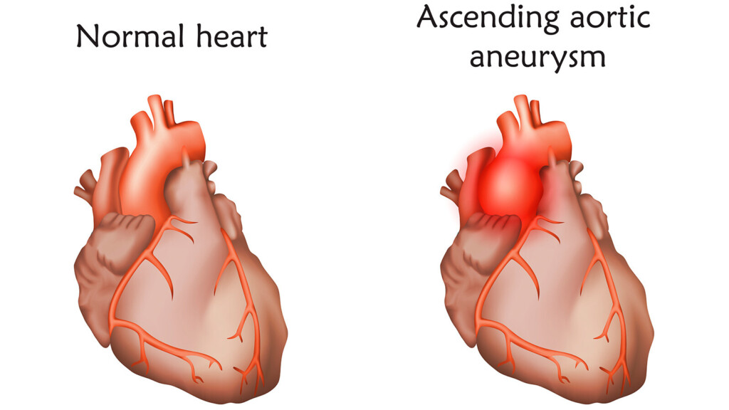 What Is An Aortic Aneurysm?