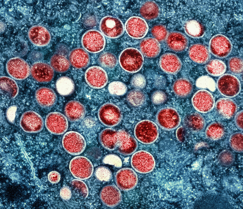 Mpox Is Almost Gone In The Us, Leaving Lessons And Mysteries In Its Wake