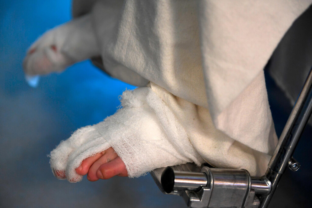 Frostbite Can Strike Quickly. Here’s What You Need To Know