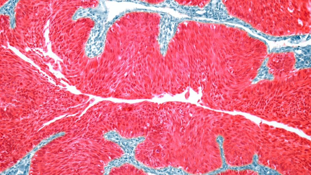 Thousands Of People Can’t Get Full Treatments Of A Lifesaving Cancer Drug