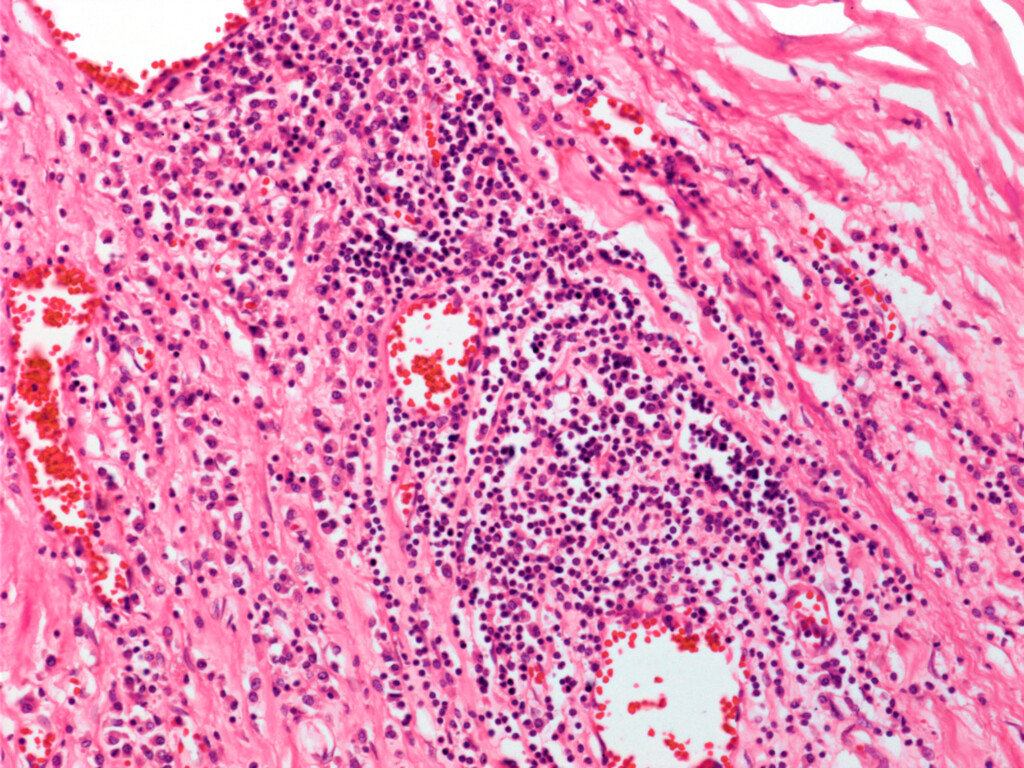 This Infection Is Completely Preventable In Infants If It’s Caught In Time, So Why Is It On The Rise?