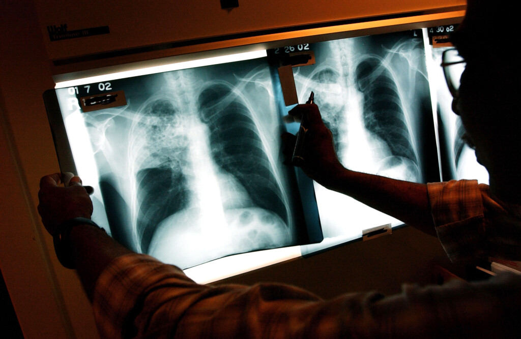 Us Tuberculosis Cases Nearing Pre Pandemic Levels, Cdc Data Shows