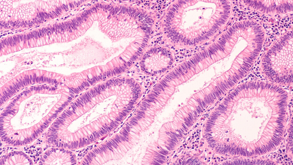 Report Shows ‘troubling’ Rise In Colorectal Cancer Among Us Adults Younger Than 55