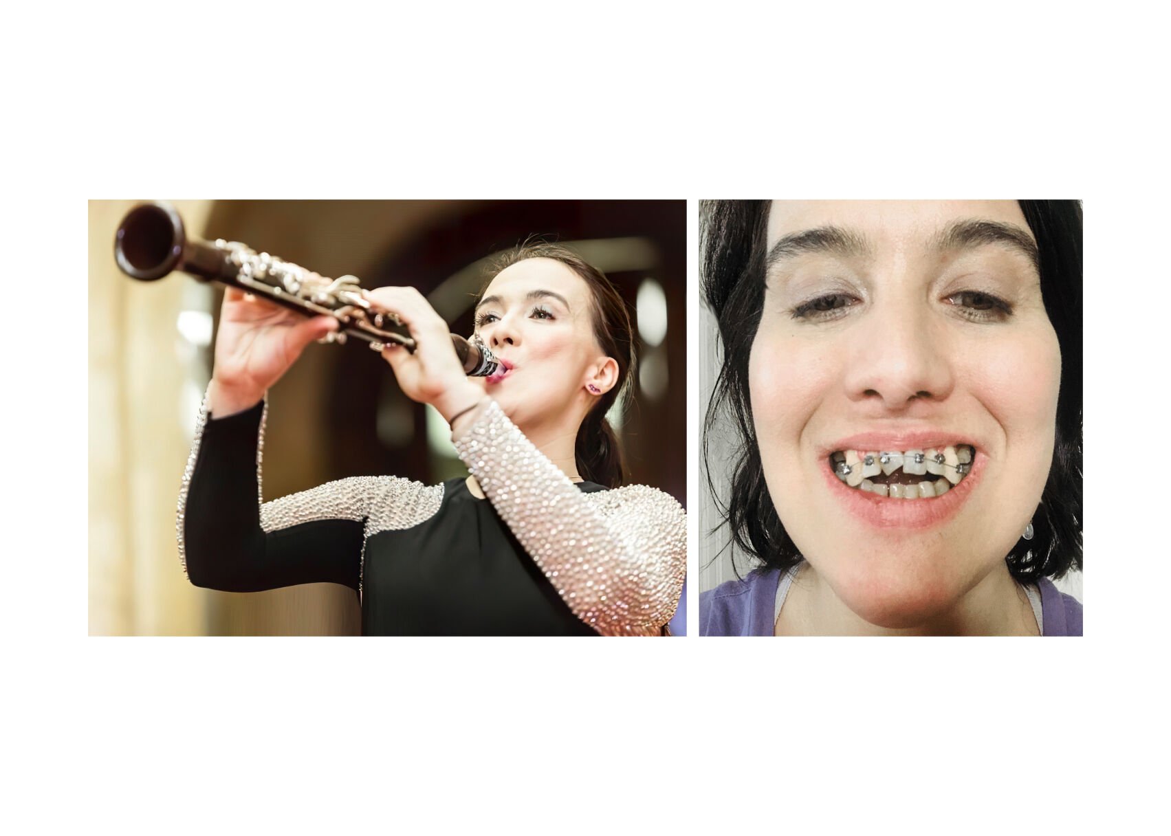 <p>Boja Kragulj, an accomplished clarinetist, says she used the AGGA (Anterior Growth Guidance Appliance) in hopes of correcting her misaligned bite and improving her breathing without surgery. Kragulj has alleged in an ongoing lawsuit that the unproven and unregulated device caused catastrophic harm to her teeth. AGGA inventor Dr. Steve Galella and his company have denied all liability. (Makris Music Society; Boja Kragulj)</p>