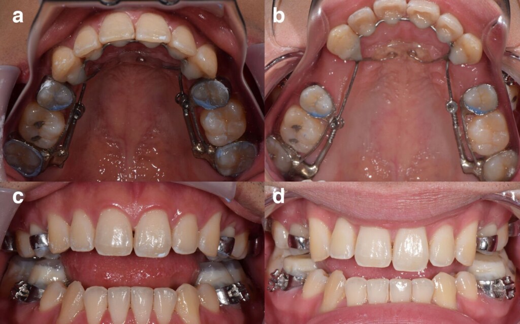 This Dental Device Was Sold To Fix Patients’ Jaws. Lawsuits Claim It Wrecked Their Teeth