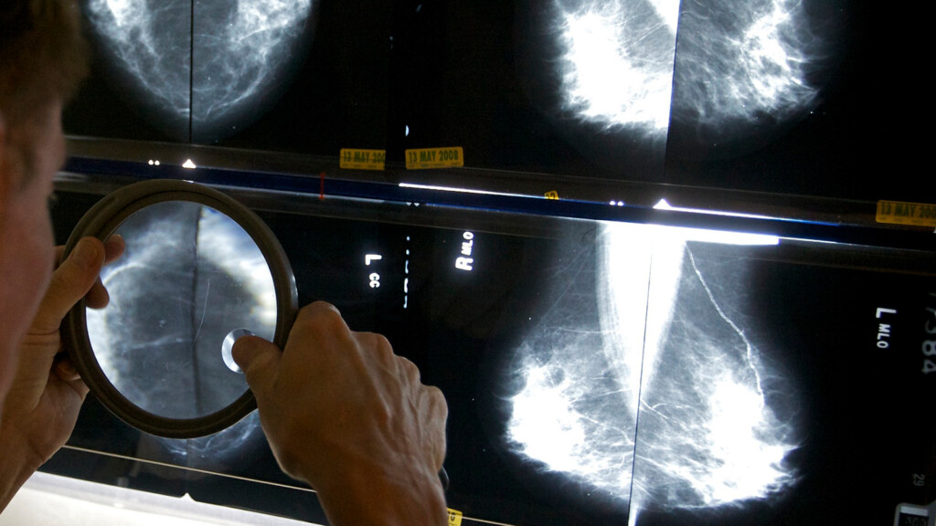 Fda To Require Mammogram Reports Include Breast Density Information