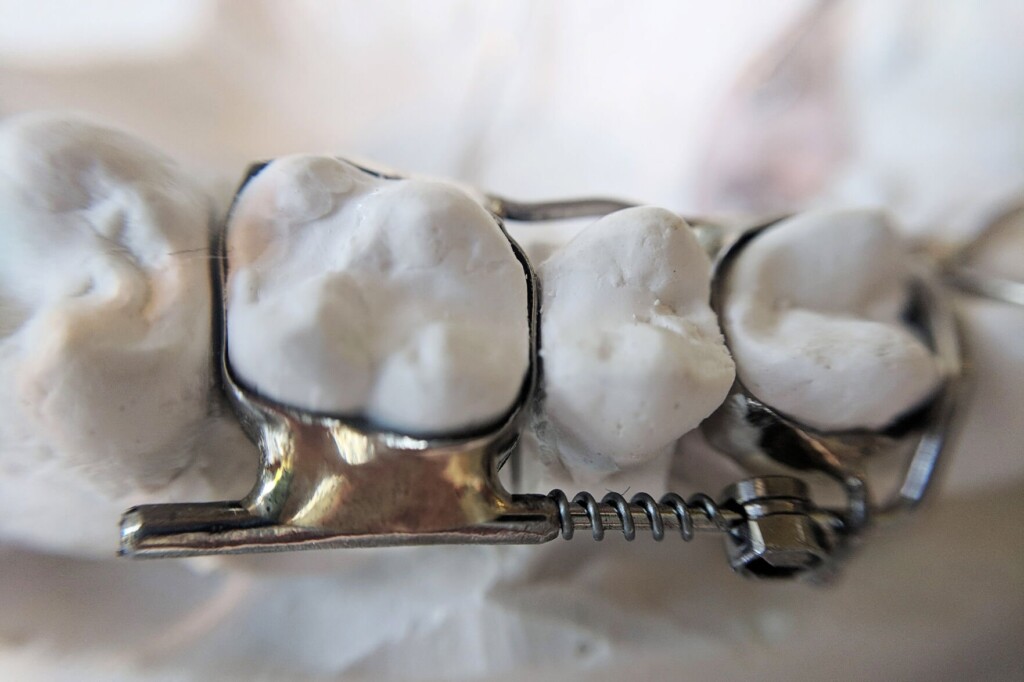 Fda Looks Into Dental Device After Khn Cbs Investigation