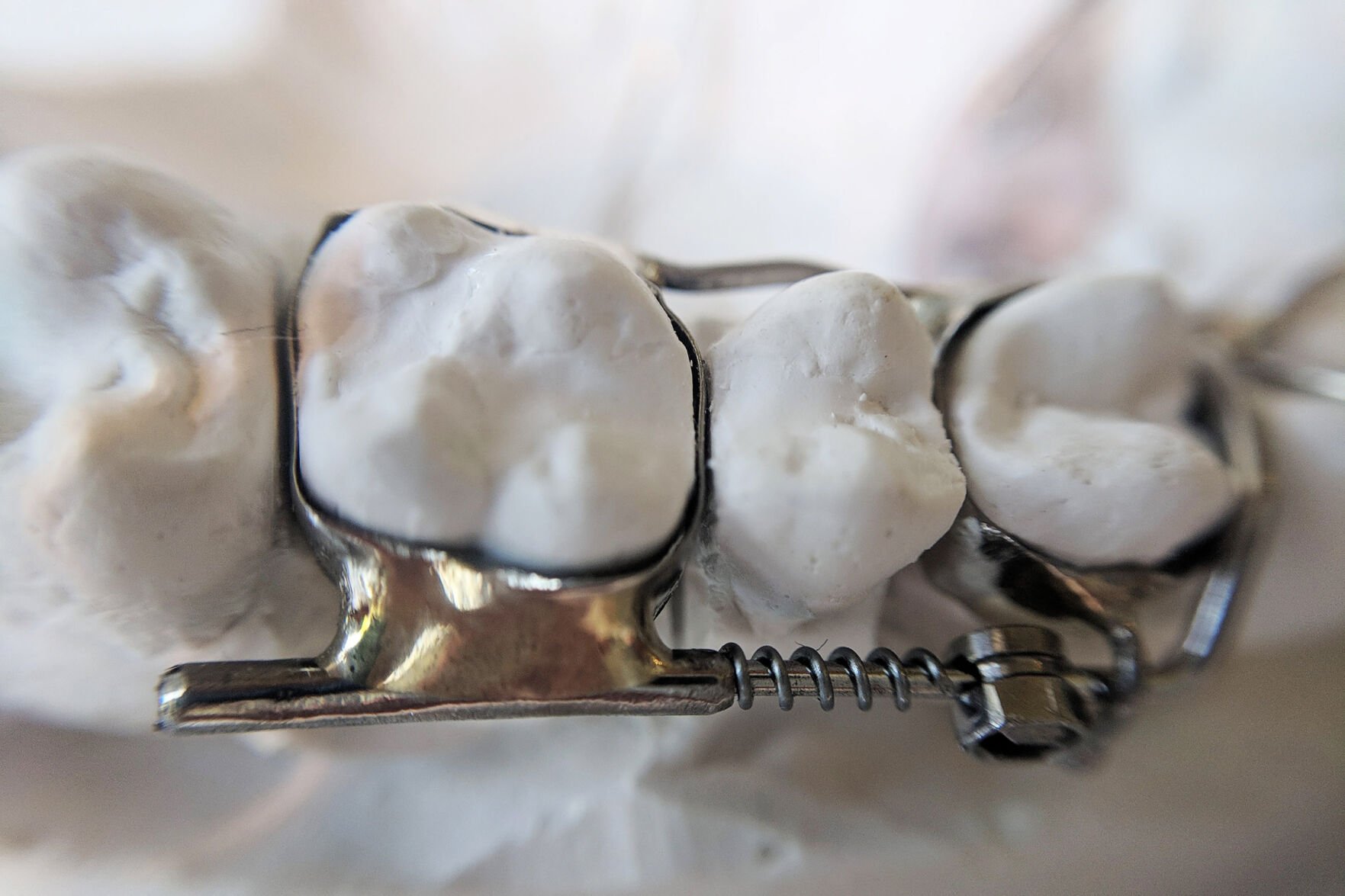 <p>An Anterior Growth Guidance Appliance, or AGGA device, is photographed before it was used by Karan Gill, who wore the device for months and alleges in a lawsuit his teeth were left loose and sensitive. The AGGA's inventor and manufacturer have denied all liability in that lawsuit.</p>