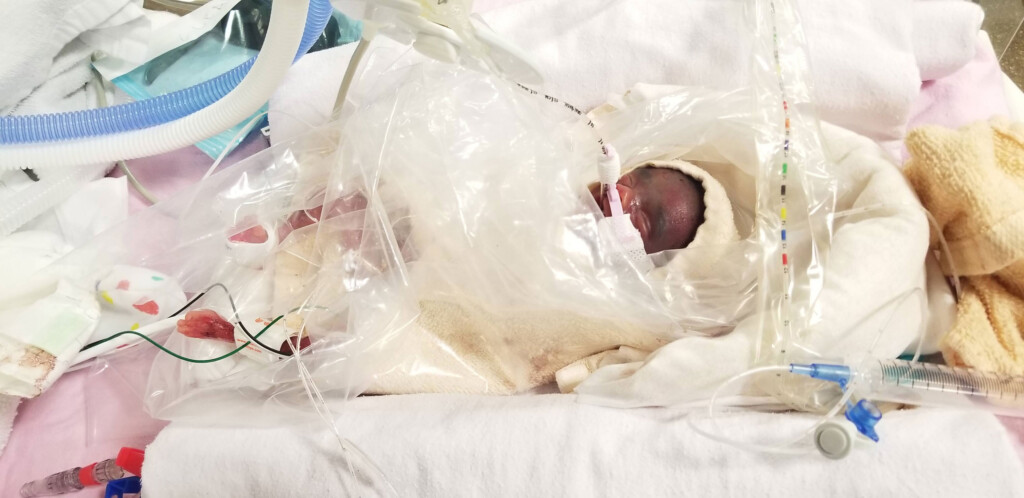 Canadian Siblings Born Four Months Early Set Record As The World’s Most Premature Twins