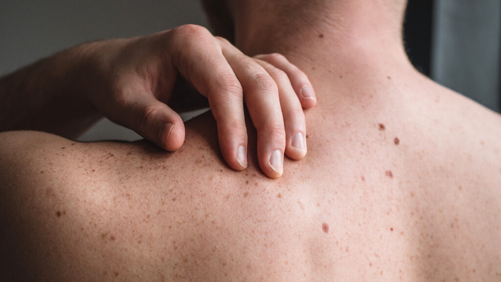 Experimental Cancer Vaccine Combined With Immunotherapy Delayed Return Of Melanoma, Moderna And Merck Say