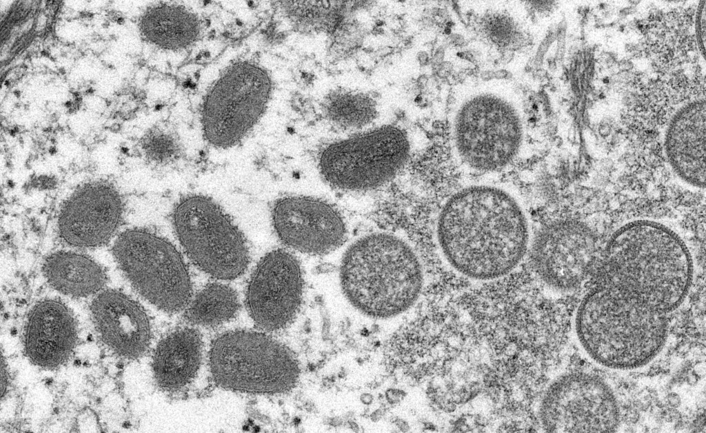 Almost 90% Of Us Mpox Related Deaths Were In Black Men, And Nearly All Had Weakened Immune Systems, Cdc Reports