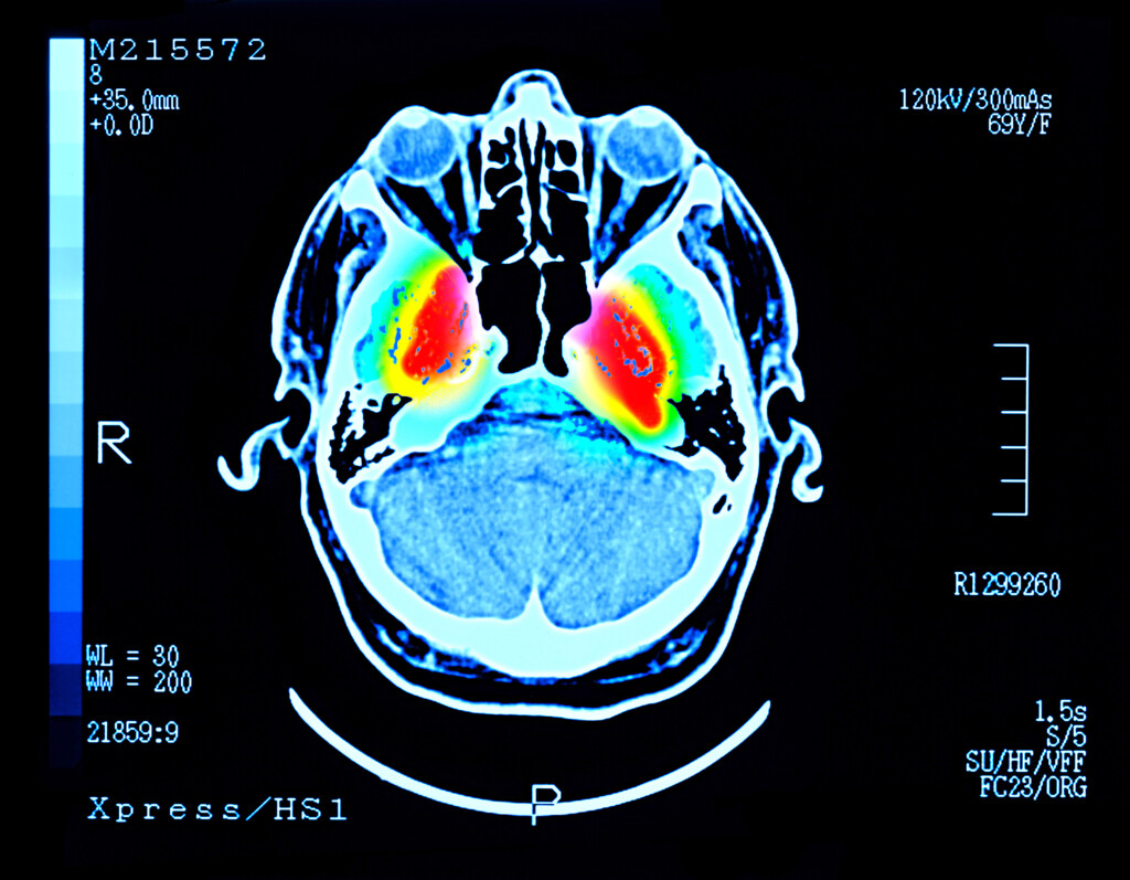 ‘big Step Forward’: New Lab Tests May Accelerate Parkinson’s Diagnosis And Research