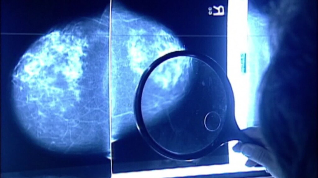 New Study Suggests Black Women Should Be Screened Earlier For Breast Cancer
