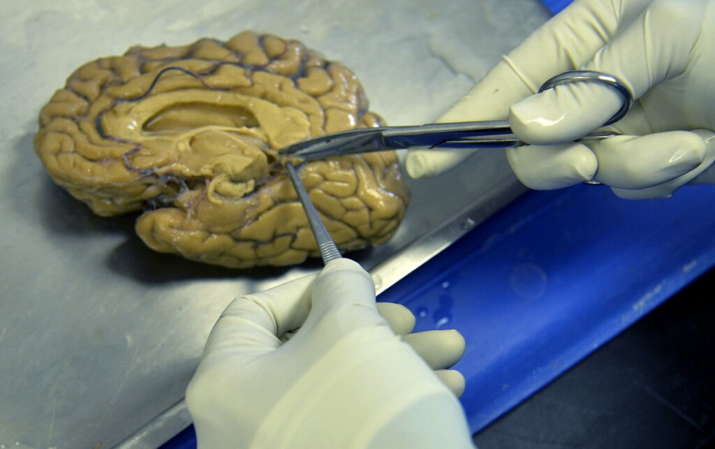 Man Who Defied Genetics For Decades May Hold A Clue To Preventing Alzheimer’s, Scientists Say