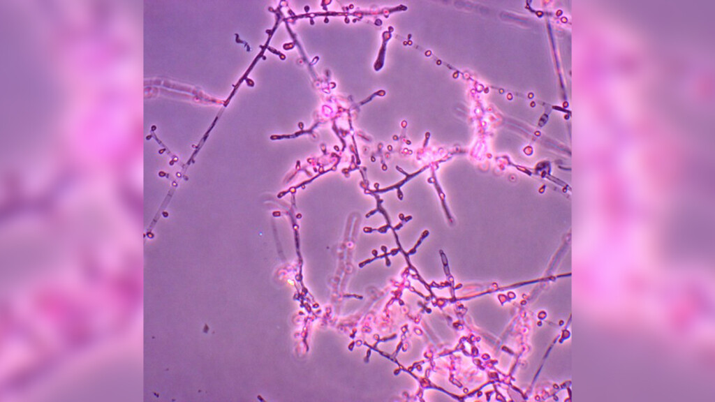 First Us Cases Of Treatment Resistant Ringworm Found In Patients In New York City