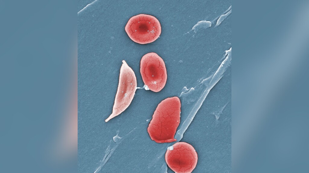 Why We Need More Black Blood Donors To Treat Sickle Cell Anemia