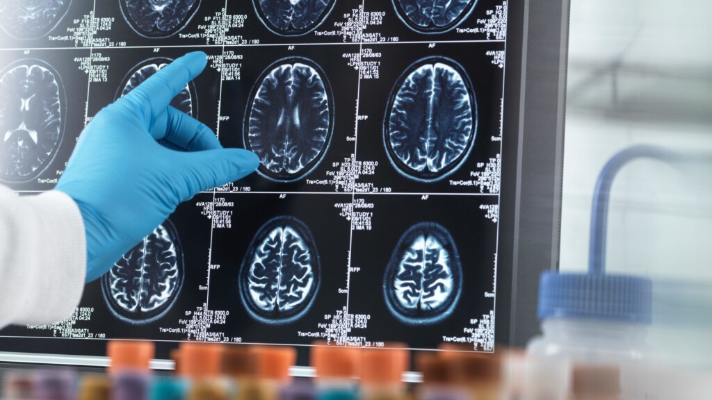 Fda Approved Alzheimer’s Drugs Will Be Covered By Medicare, With Some Limitations, Cms Says