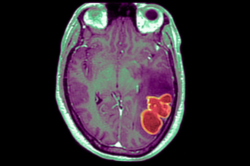 Brain Abscesses Increased Nationally In Children Last Winter, But Remain Rare, New Cdc Investigation Finds