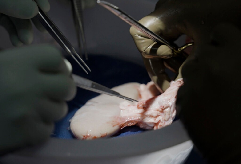 Pig Kidney Works In A Donated Body For Over A Month, A Step Toward Animal Human Transplants