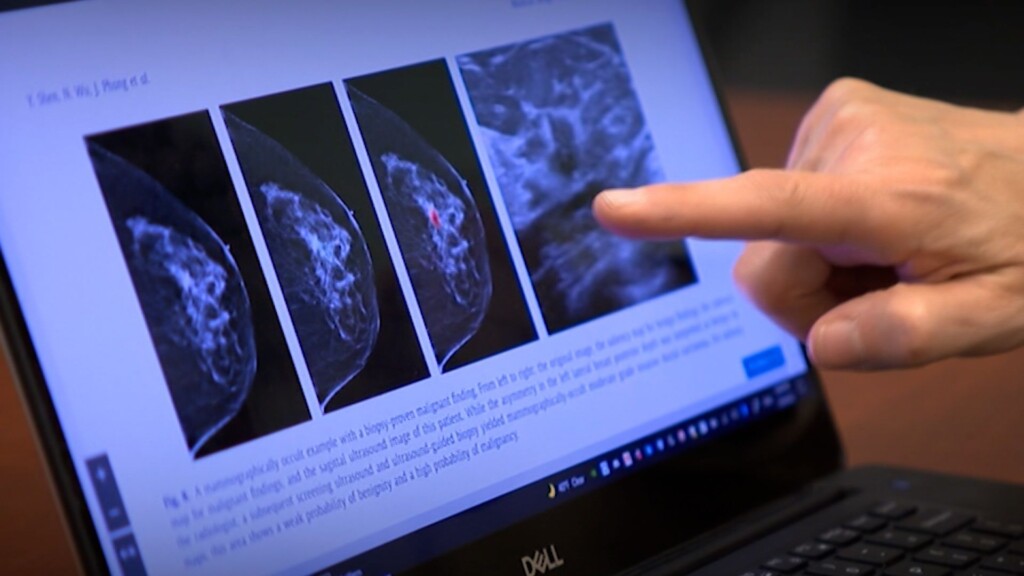 Ai Supported Mammogram Screening Increases Breast Cancer Detection By 20%, Study Finds