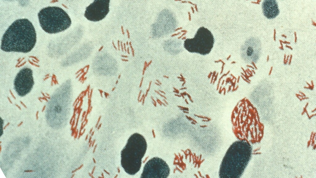 Central Florida Is A Hotspot For Leprosy, Report Says