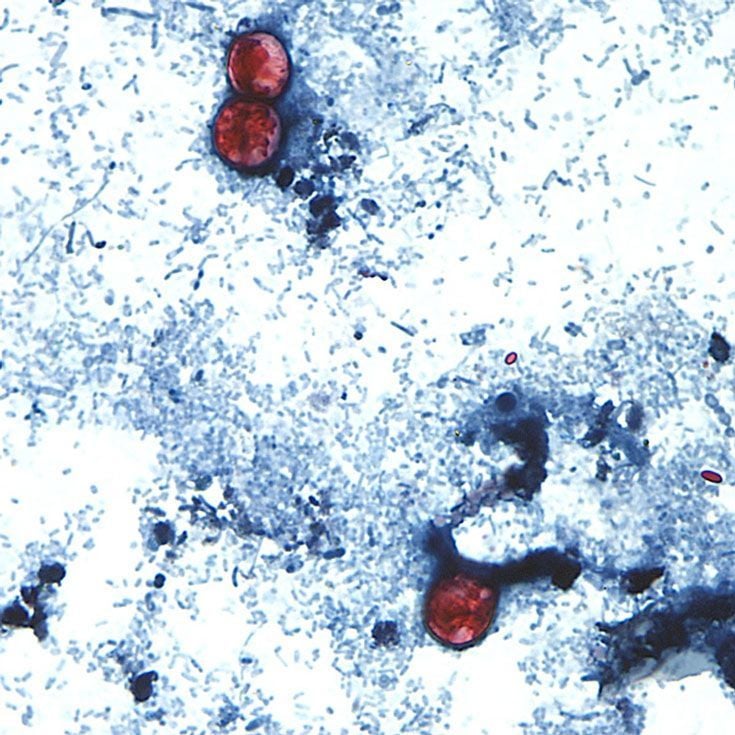 Cyclospora Outbreak Declared Over By The Cdc