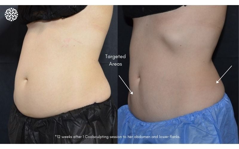 CoolSculpting Elite, 50% Off Packages