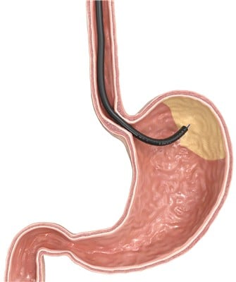 Gma With Moviva®: Setting New Standards In Endoscopic Bariatric Treatment