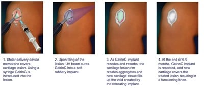 Regentis Biomaterials Commences Trading On Nyse: Set To Transform Cartilage Repair Market With Off The Shelf Regenerative Product