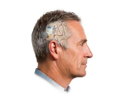 Nia Therapeutics Publishes Peer Reviewed Validation Of A 60 Channel Brain Implant For Closed Loop Neurostimulation