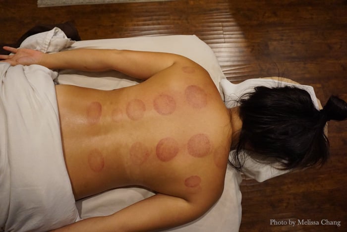 You'll get hickey-like marks on your back after the treatment.